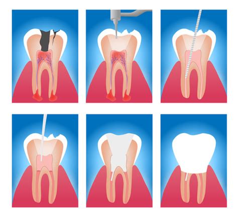 Signs And Symptoms Of Root Canal Problems