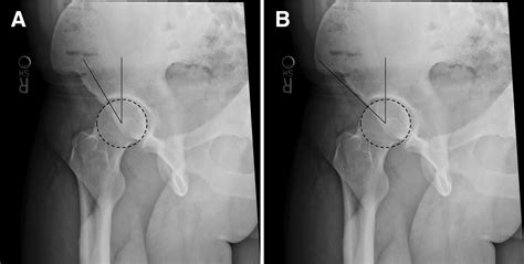 Assessment Of Acetabular Morphology Using The Acetabular Anterior