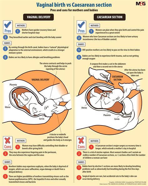 The Pros And Cons Of C Sections And Vaginal Births The Mail And Guardian