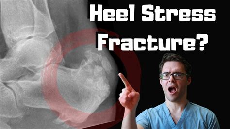 Stress Fracture Of The Calcaneus Symptoms Causes And Best Treatment