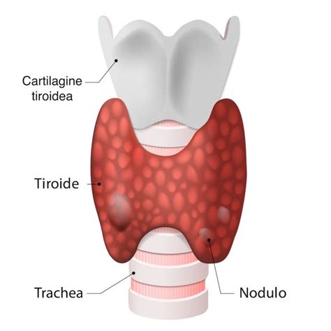 Cosa Sono I Noduli Della Tiroide