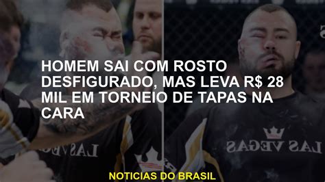 O Homem Sai O Rosto Desfigurado Mas Leva US 28 000 Em Um Torneio