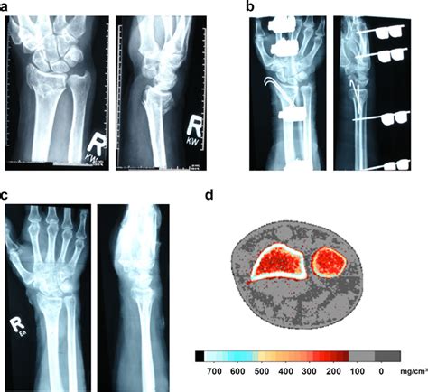 A Preoperative X Ray Photograph In Anterior Posterior And Lateral View Download Scientific