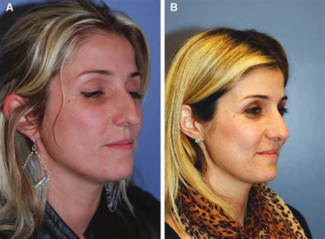 Preoperative A And Postoperative B Right View Images Of A