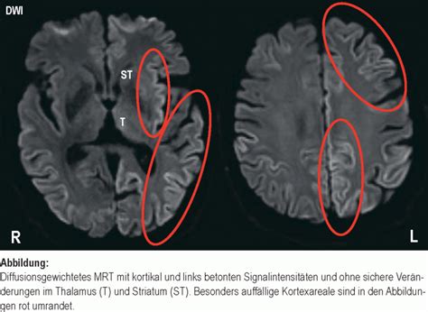Kortikale Signalver Nderungen Bei Creutzfeldt Jakob Erkrankung