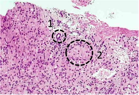 Liver Biopsy Showing Moderate To Severe Interface Hepatitis With Portal