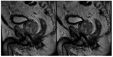 Cancers Free Full Text Accelerated T2 Weighted Tse Imaging Of The