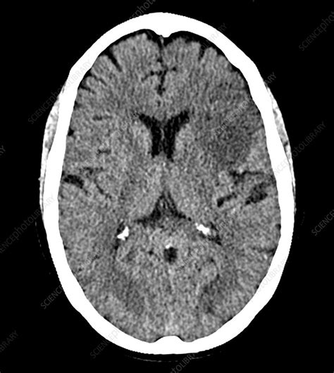 Broca's Aphasia, CT Scan - Stock Image - C030/5552 - Science Photo Library