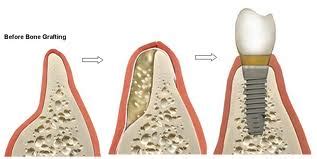 Bone Graft And Sinus Lift Procedures Dr Ari Greenspan Dentist