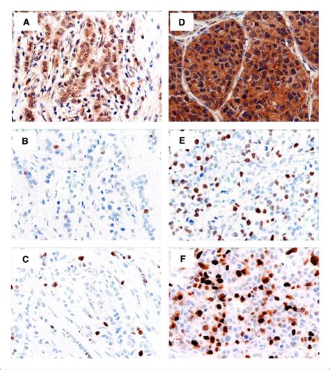 Immunohistochemical Staining Of Chk E F And Ki In Breast