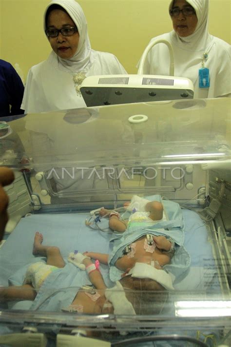 Kelahiran Bayi Kembar Siam Antara Foto