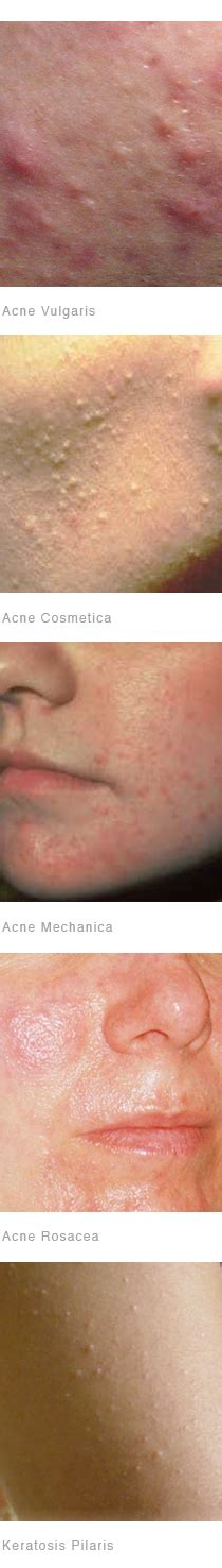 Acne Skin The Most Common Skin Disease Affected By Of Teenagers