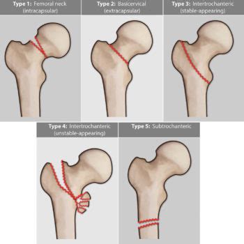 Femoral Neck Fracture Causes Types Symptoms Diagnosis Treatment