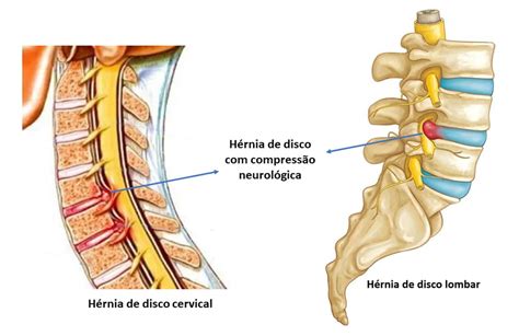 Tratamento Da H Rnia De Disco Dr Ricardo Teixeira