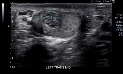 Testicular Adrenal Rest Tumors Or Bilateral Leydig Cell Tumors Urology