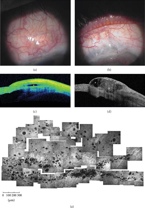 Figure 2 From Anterior Segment Optical Coherence Tomography Imaging Of