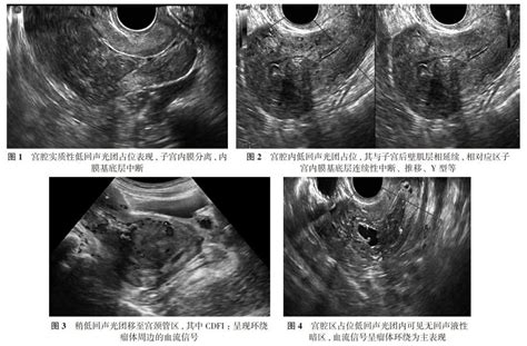 子宫黏膜下肌瘤的超声诊断参考网