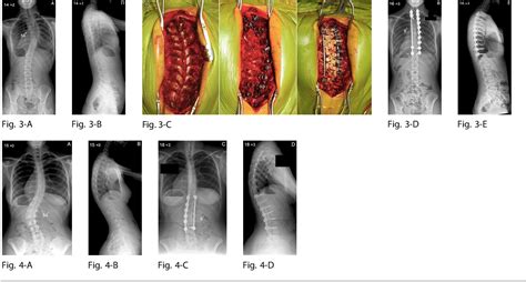 Correction Of Adolescent Idiopathic Scoliosis Using A Convex Pedicle Screw Technique A Novel