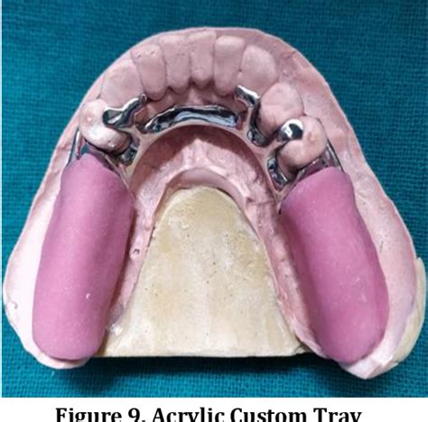 Figure 1 From Mandibular Distal Extension Cast Partial Denture Using