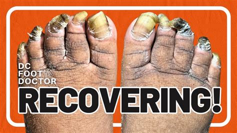 Recovering Trimming Fungal Toenails YouTube