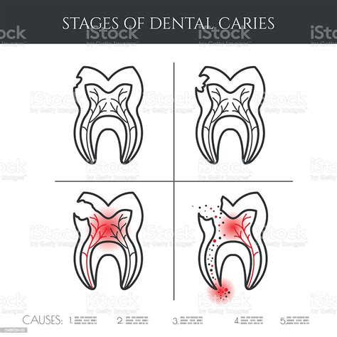 Dental Caries Stages Stock Illustration - Download Image Now ...