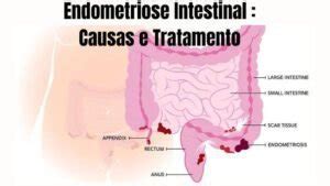 Endometriose Intestinal Sintomas Riscos E Tratamento