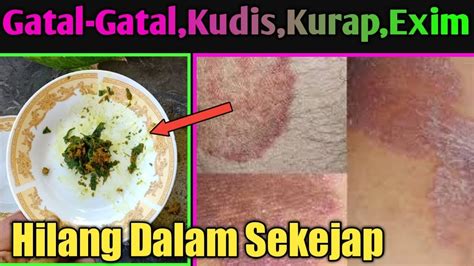 Tidak Banyak Orang Tahusakit Kulit Dan Gatal Gatal Menahun Hilang