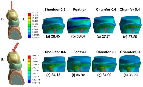 Comparison Of Different Cervical Finish Lines Of All Ceramic Crowns On