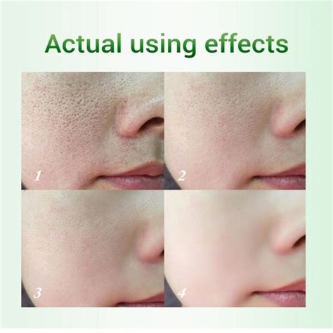 20ml Salicylic Acid Pores Refining Cream Shrink Pore Improve Acnes