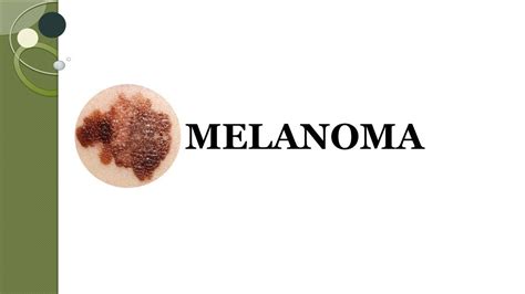 Melanoma Pathophysiology Stages And Treatment Youtube