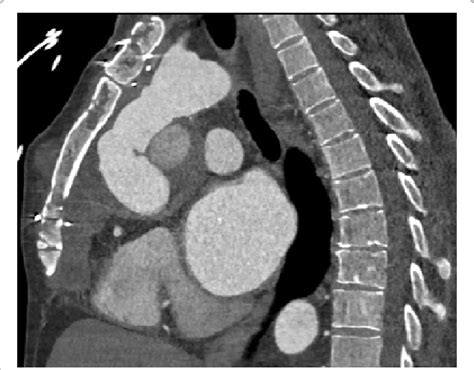 Case Ct Sagittal View Showing Close Proximity Of Ascending Aorta To