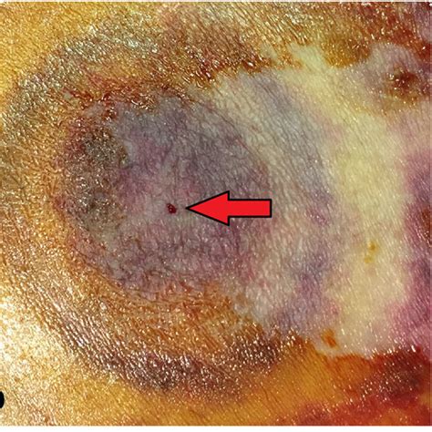 Ascites Leak After Autologous Blood Injection A Leakage Of Ascitic