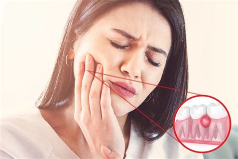 What Happens If A Tooth Abscess Burst On Its Own