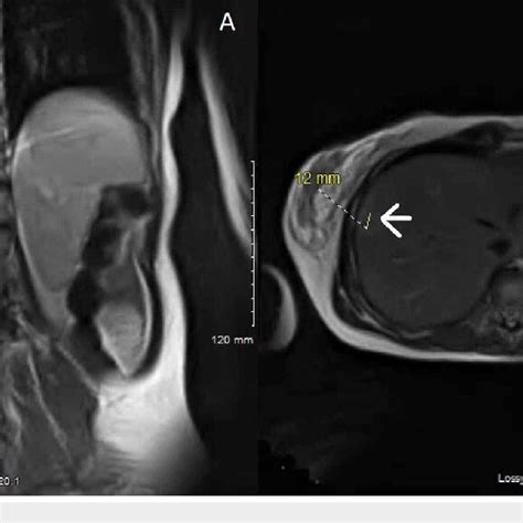 Magnetic Resonance Imaging A B Two Non Specific Hepatic Lesions