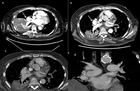 Pulmonary Artery Pseudoaneurysms In The Setting Of Gout Polyarthropathy