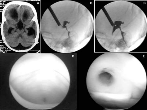 A Case Of Obstructive Hydrocephalus Aqueductal Stenosis Case No 1 Download Scientific