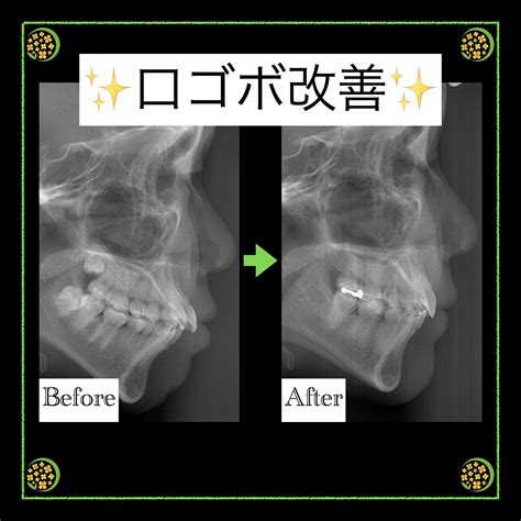 「口ゴボ」改善 新大阪の歯医者｜やみか歯科・矯正歯科