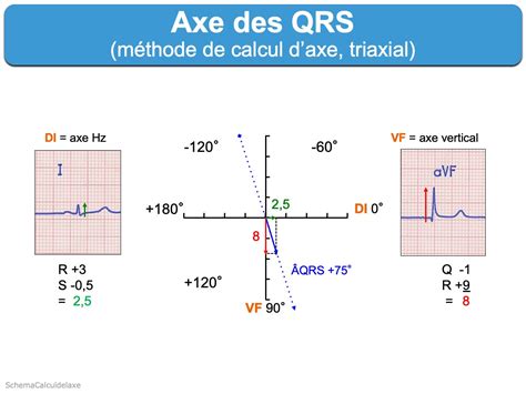 Complexe Qrs E Cardiogram