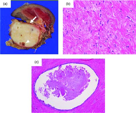 Gross Pathologic Specimen Showed That The Tumor Arrow Was A Solid