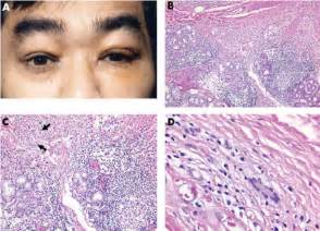 A Clinical Photograph Showing Bilateral Lacrimal Gland Enlargement