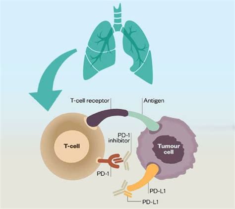 Immunotherapy for Lung Cancer in Mexico | No Chemo - No Radation