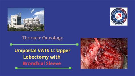 Uniportal Vats Left Upper Lobectomy With Bronchial Sleeve Resection