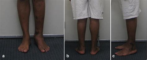 Limb Salvage Reconstruction Of The Ankle With Fusion And Simultaneous