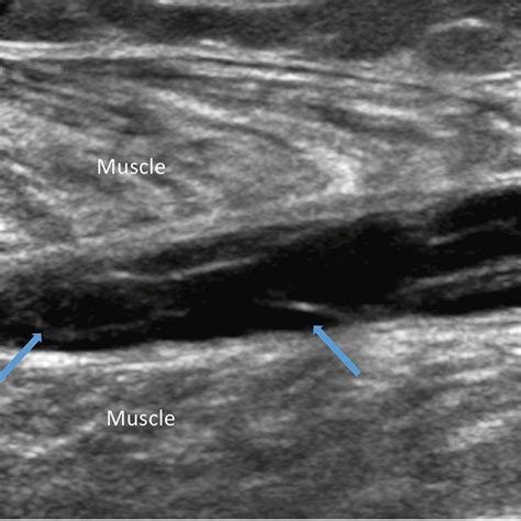 Hematoma From Plantaris Muscle Injury Gray Scale Image Of The Right