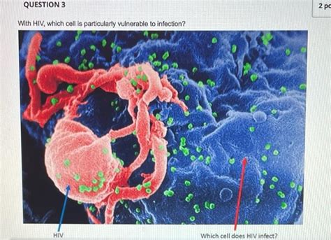 Solved In the following cardiac histology, an Aschoff Body | Chegg.com