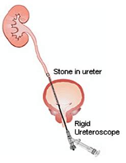 BIOMED ALL INVITED: Kidney Stone Removal using Lasers