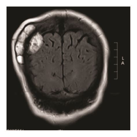 A Preoperative Axial Ct Scan Of The Brain Bone Window Showing