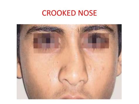 Disease Of External Nose And Nasal Cavity Ppt