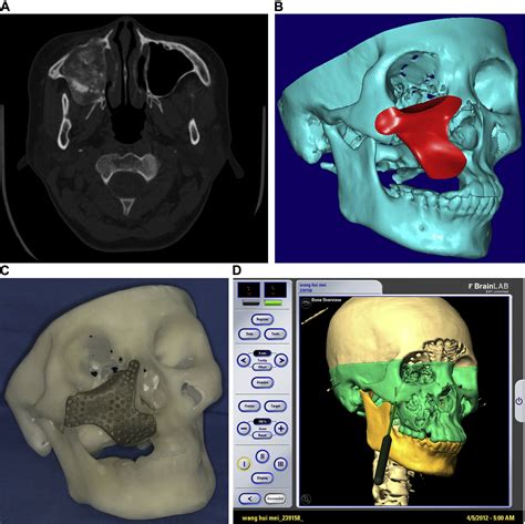 References In Surgical Reconstruction Of Maxillary And Mandibular