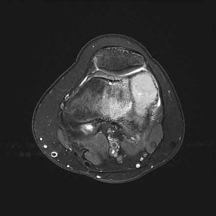 Phase Encoded Motion Artifact Radiology Reference Article